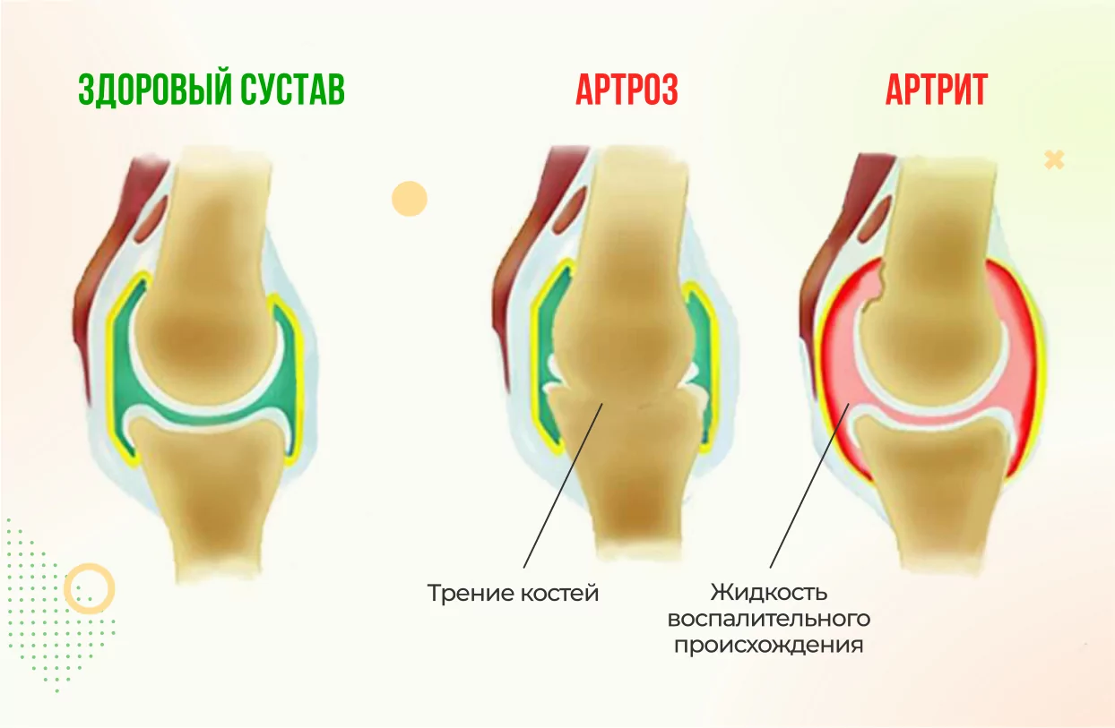 Причины суставной боли при инфекционном артрите