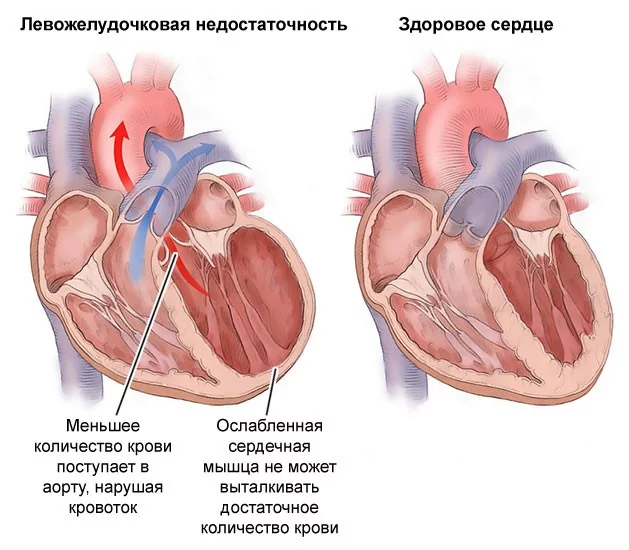 infarkt-miokarda-0002.jpg