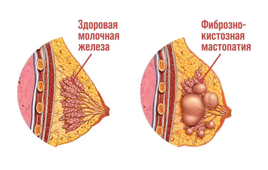 Диффузная фиброзно-кистозная мастопатия: симптомы, причины и методы лечения