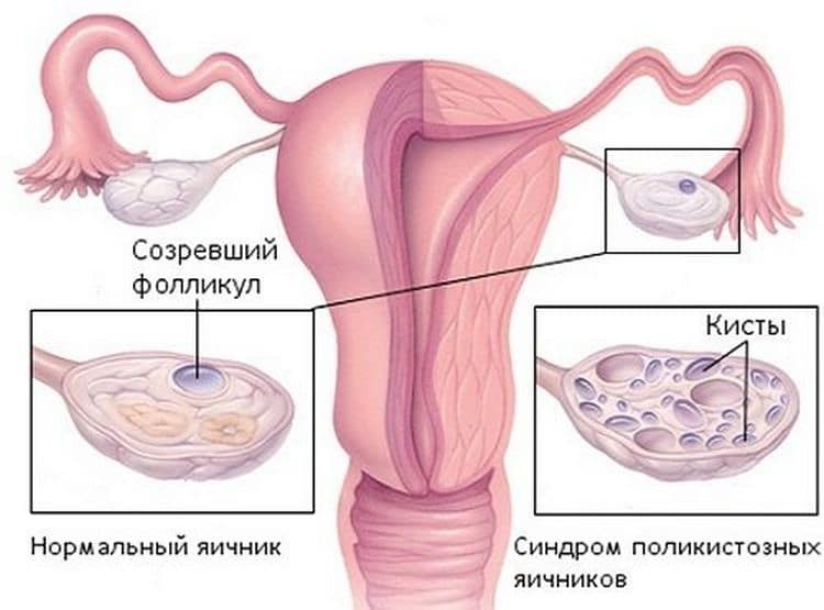 Синдром поликистозных яичников (СПКЯ): что это такое у женщин, каклечить