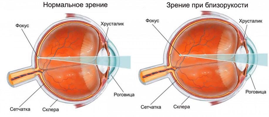 Фокусировка изображения на сетчатке